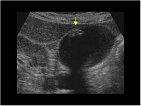 Abdomen and retroperitoneum | 1.2 Gallbladder and bile ducts : Case 1.2.1 Gallbladder ...