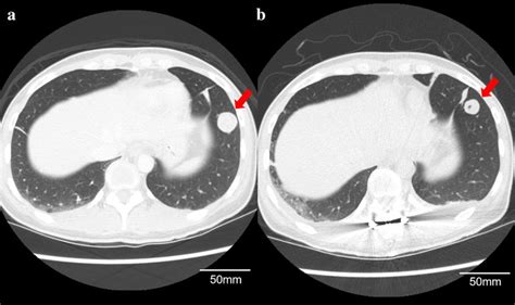 Pre And Postoperative Chest Computed Tomography Images Before Surgery