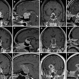 Anterior Posterior Diameter Is A Key Driver Of Resectability And