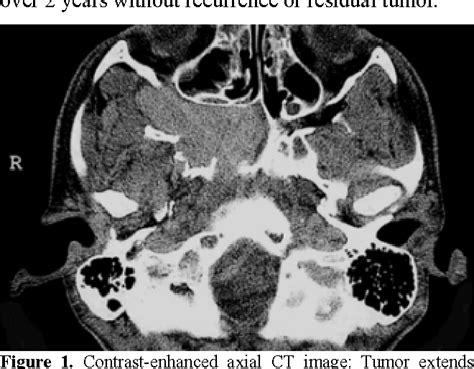 Figure 1 From Juvenile Nasopharyngeal Angiofibroma Radiologic