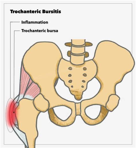 Greater Trochanteric Bursa Injection Statpearls Ncbi Bookshelf