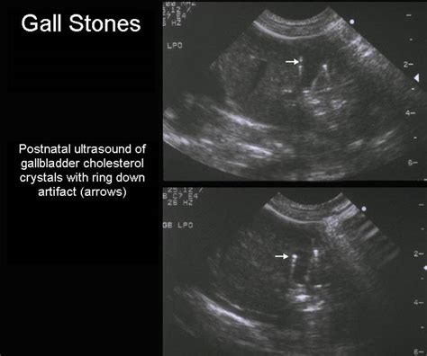 Fetal Gallbladder And Tumefactive Sludge