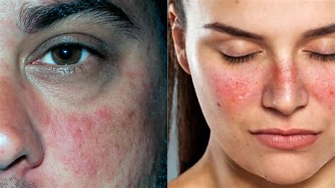 Kelebek Hastalığı Lupus nedir Kelebek Hastalığı Lupus belirtileri