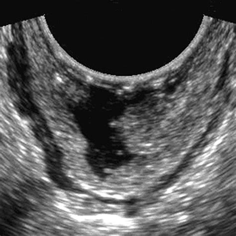 Perspective On The Role Of Transrectal And Transvaginal Sonography Of