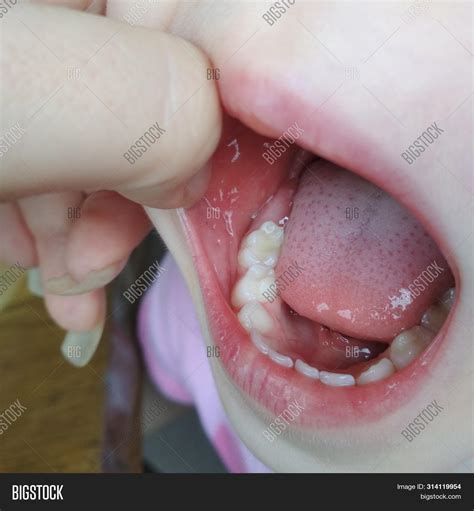 Stomatitis