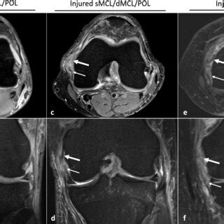 T2 Weighted Axial And Coronal MRI Sequences Images A And B Show An