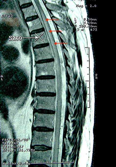 Syrinx Spinal Cord C N S Neurosurgery