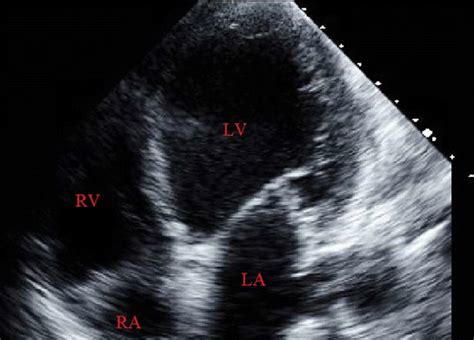 Neurogenic Stunned Myocardium Transthoracic Echocardiography Apical