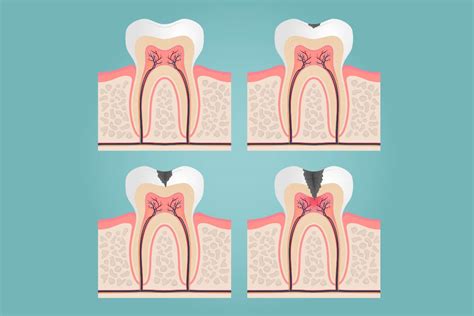 Diferencias Entre Un Empaste Y Una Endodoncia CIO Arturo Soria