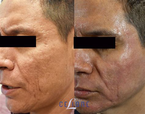 Laser Skin Resurfacing Pores