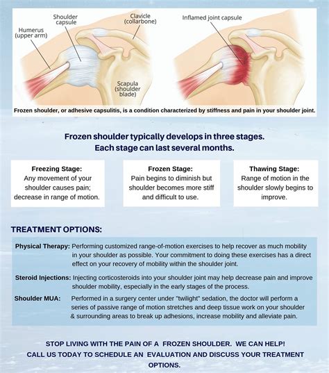 Got Frozen Shoulder? | Bissell Clinic