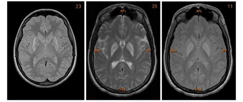 Basal Ganglia Damage