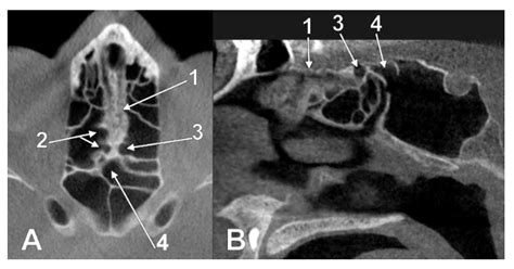 Patterns Of Pneumatization Of The Posterior Nasal Roof