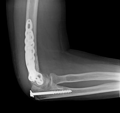 Elbow Fracture Treatments Dr Skedros Orthopaedics