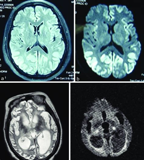 Creutzfeldt Jakob Disease Brain