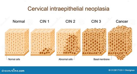 Cervical Dysplasia Cervical Cancer Stock Vector Illustration Of