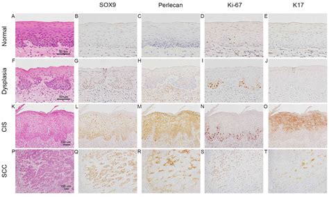 Cytoplasmic Expression Of Sox As A Poor Prognostic Factor For Oral