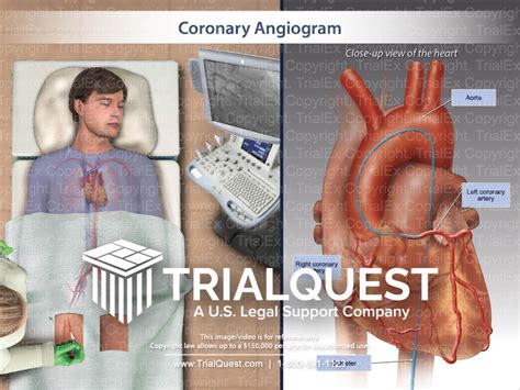 Coronary Angiogram - TrialQuest Inc.