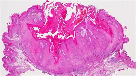 Keratoacanthoma Histology