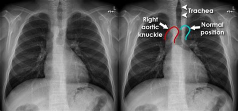 Aortic Arch Chest X Ray