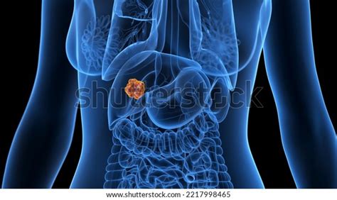 3d Rendered Medical Illustration Liver Tumor Stock Illustration 2217998465 Shutterstock