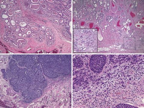 Representative Examples Of Tumor Grade And Budding A Low Grade Tumor Download Scientific