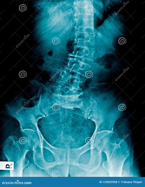 脊柱侧凸腰部x 射线图象 库存照片 图片 包括有 痛苦 关心 投反对票 臀部 爱好健美者 诊断 123029958