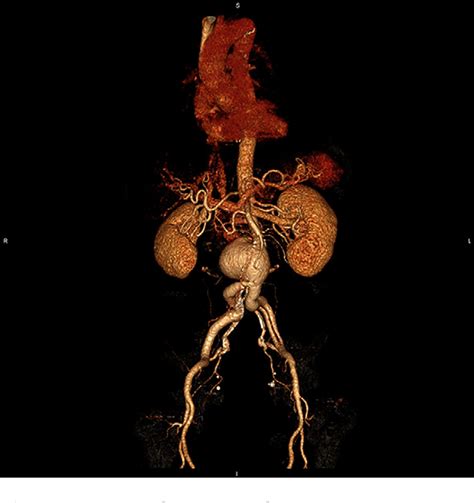 Figure From Endovascular Repair Of A Ruptured Abdominal Aortic