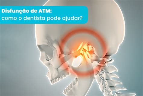 Disfun O De Atm Como O Dentista Pode Ajudar Blog Odonto Equipamentos