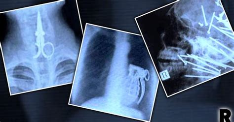 Inside Story! Weird Objects & Horrifying Injuries Caught On X-Ray!