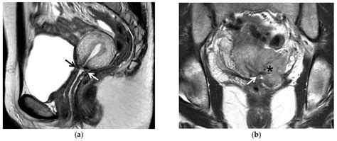 Cancers Free Full Text Useful Mri Findings For Minimally Invasive Surgery For Early Cervical