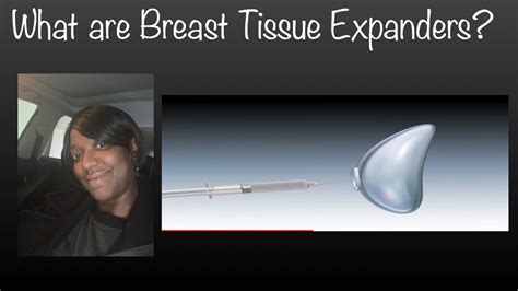 Breast Tissue Expanders Youtube