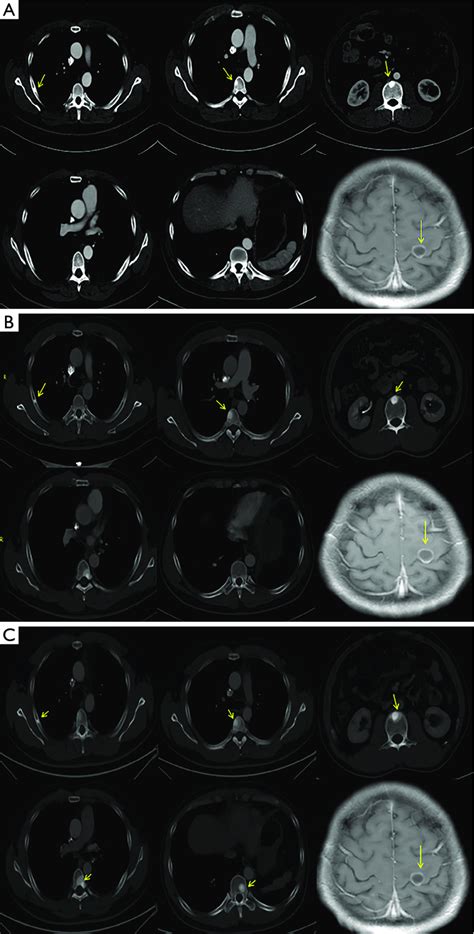 Ct And Brain Mri Scans During Therapy A Ct And Mri Scans Before The