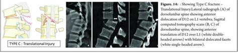 Thoracolumbar Fractures Classification And Clinical Relevance