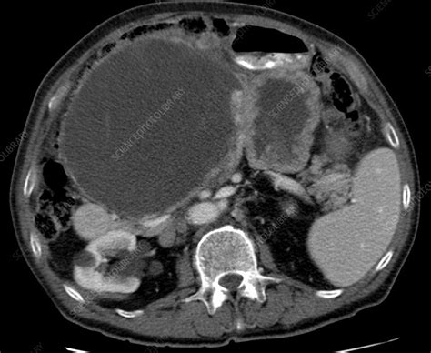 Gastrointestinal Stromal Tumour Ct Scan Stock Image C