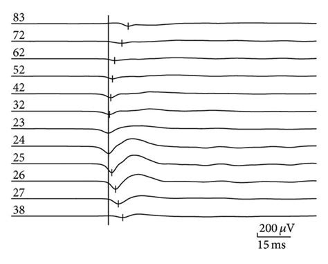 Effects Of Vpa On The Initiation And Propagation Of The Interictal Download Scientific Diagram