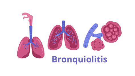 Qu Es El Virus Respiratorio Sincitial S Ntomas Tratamiento Y Efectos