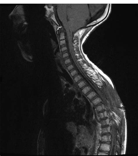 Syringomyelia | Neupsy Key