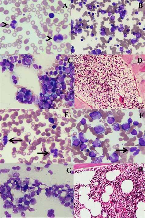 Findings On Peripheral Smear PS And Bone Marrow BM Examination In