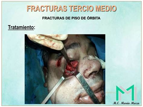 Fracturas Faciales Tercio Superior Y Medio Ppt