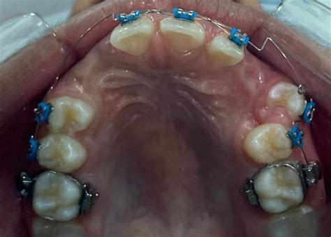 Tracionamento De Canino Incluso Na Maxila Relato De Caso Cl Nico