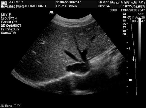 Pancreas: Ultrasound Of Liver Gallbladder And Pancreas