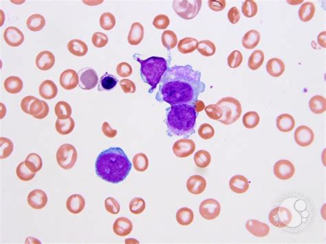 Transient myeloproliferative disorder