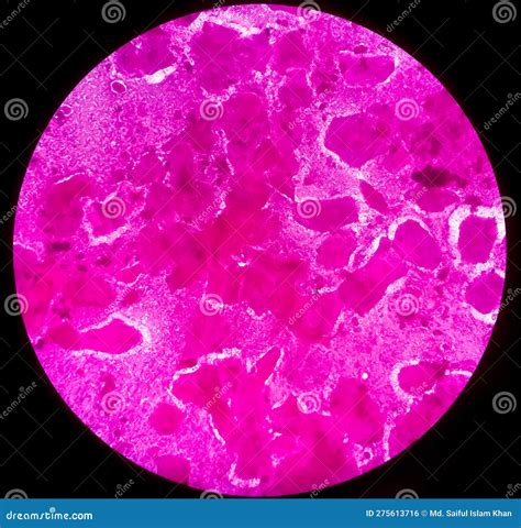 Sputum Smear Under Microscopy Showing Gram Positive Cocci Bacteria ...