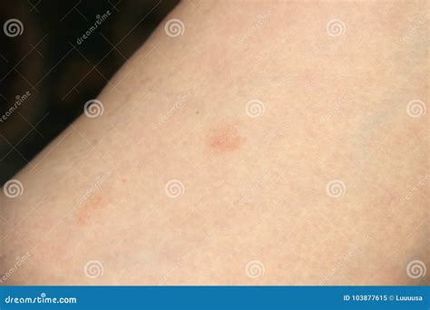 Pityriasis Rosea Three Weeks After The Appearance Of The First Focus On