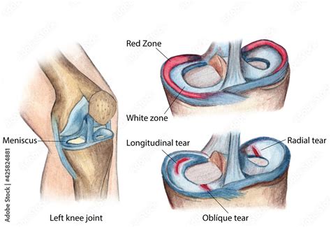 anatomy of the human knee meniscus tears Stock Illustration | Adobe Stock