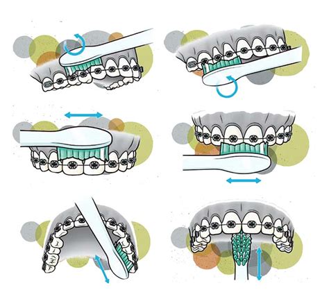 Higiene Bucal Con Ortodoncia Por El Dr Fernando De La Iglesia