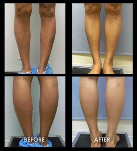 before-after-calf-implants-18 | Gravity Medical Spa