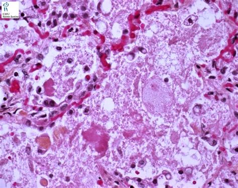 alveolar proteinosis humpathcom human pathology