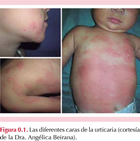 Actualizar Imagen Urticaria Por Mariscos Tratamiento Abzlocal Mx